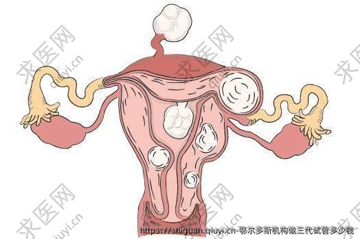 鄂尔多斯机构做三代试管多少钱