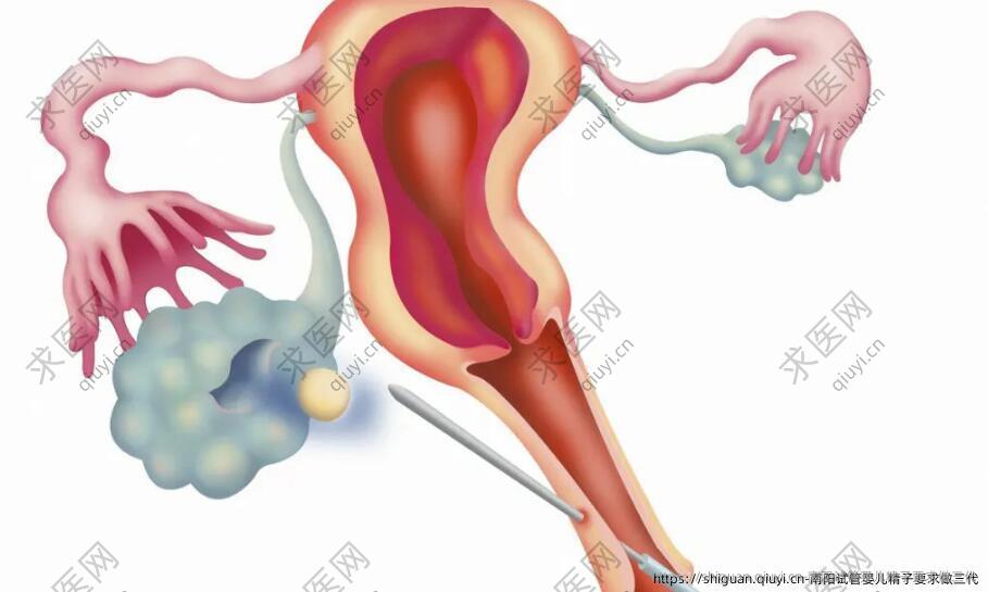 南阳试管婴儿精子要求做三代