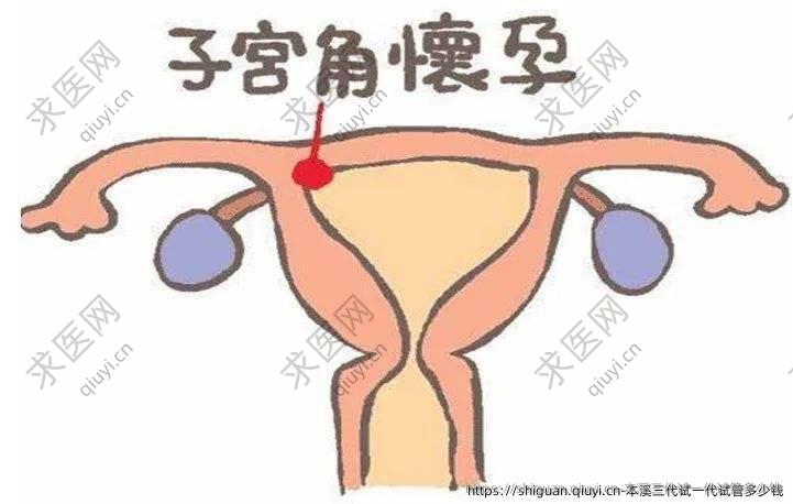 本溪三孕试一孕试管多少钱